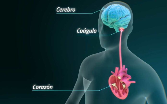 infarto cerebral infarto cerebral